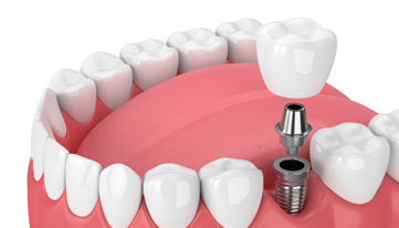 What Are Dental Implants 1