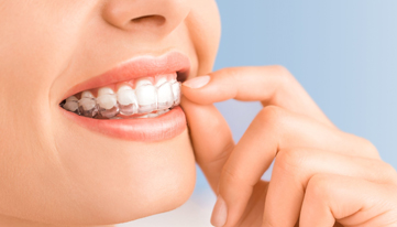 Who Is A Candidate For Invisalign