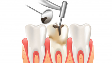 Who Is A Candidate For Root Canals