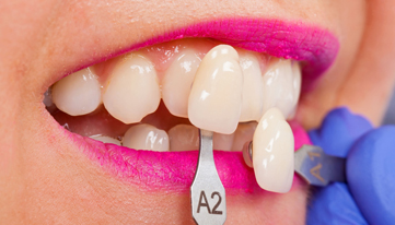 Who Is A Good Candidate For Porcelain Veneers