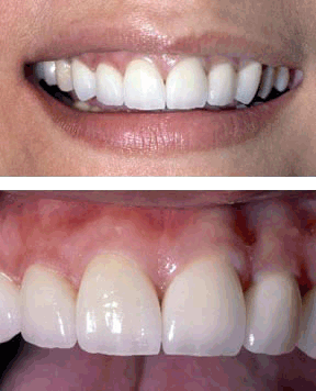 Anterior Crowns After.gif