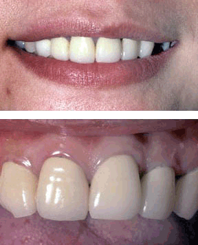 Anterior Crowns Before.gif