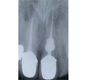 Endo7after.gif
