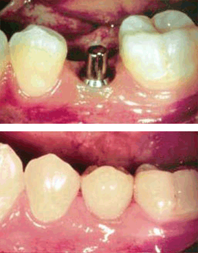Implant 05 After.gif