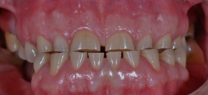 dentalattrition