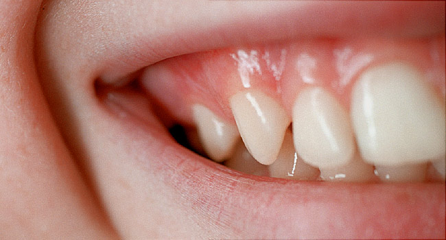 Why Do Teeth Experience Gum Infections?