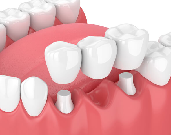 what are dental bridges new