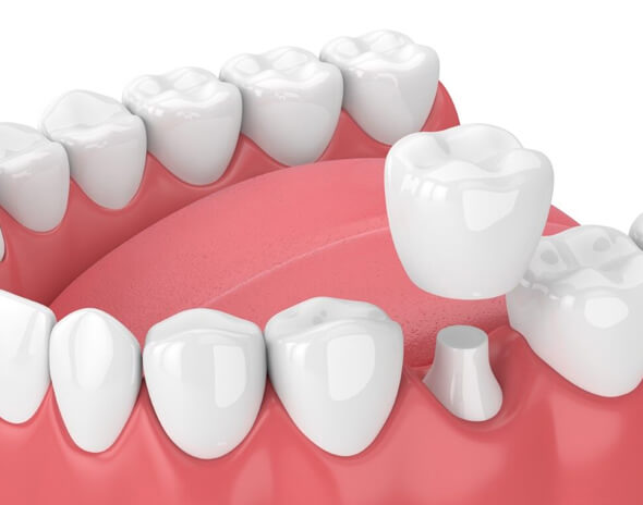 what are dental crowns new