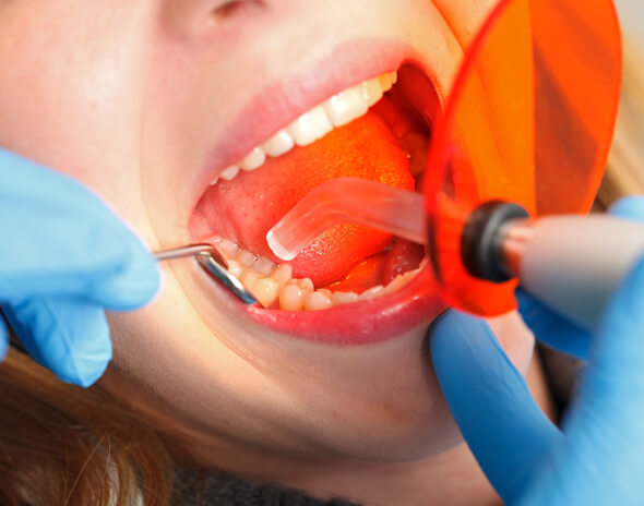 what is dental bonding new
