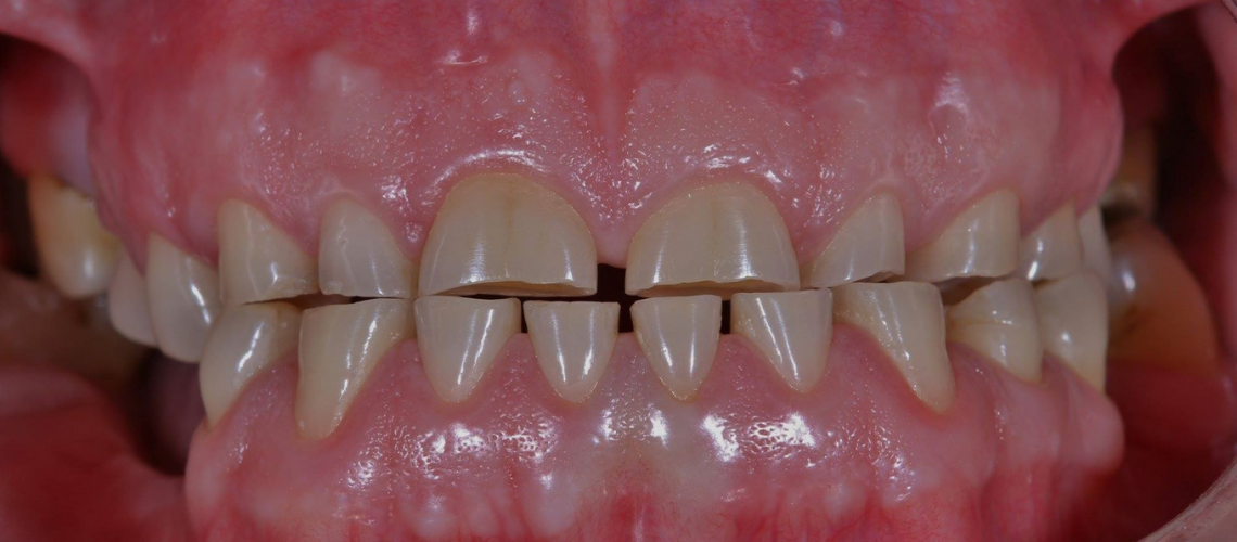 types-and-causes-of-tooth-wear-dr-emily-letran