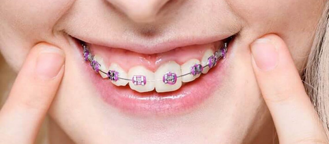 Differences Between Ceramic And Sapphire Brackets
